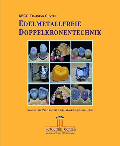 Edelmetallfreie Doppelkronentechnik: Kombinierte Prothese mit Doppelkronen und Modellguss