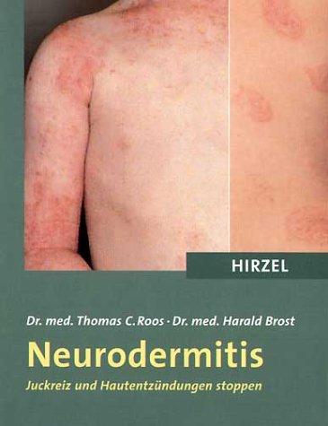 Neurodermitis. Juckreiz und Hautentzündungen stoppen