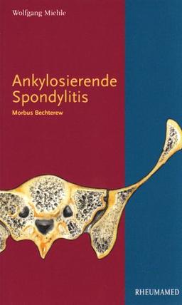 Ankylosierende Spondylitis: Morbus Bechterew