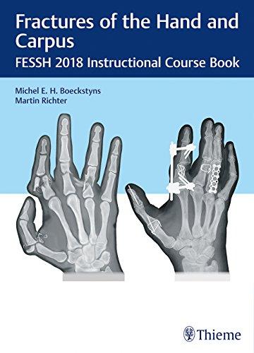 Fractures of the Hand and Carpus: FESSH 2018 Instructional Course Book