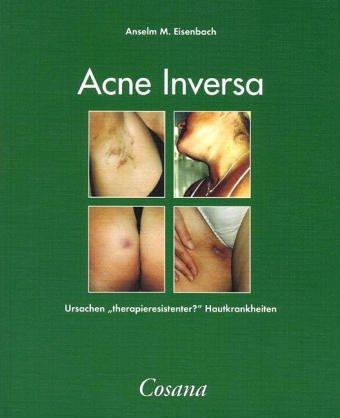 Acne Inversa