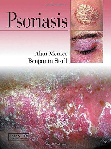 Psoriasis