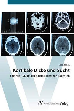 Kortikale Dicke und Sucht: Eine MRT-Studie bei polytoxikomanen Patienten