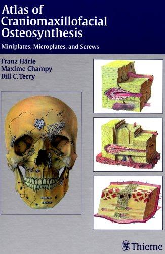 Atlas of Craniomaxillofacial Osteosynthesis: Microplates, Miniplates, and Screws: Micro-miniplates and Screws