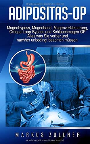 Adipositas-OP: Magenbypass, Magenband, Magenverkleinerung, Omega-Loop-Bypass und Schlauchmagen-OP - Alles was Sie vorher und nachher unbedingt beachten müssen.