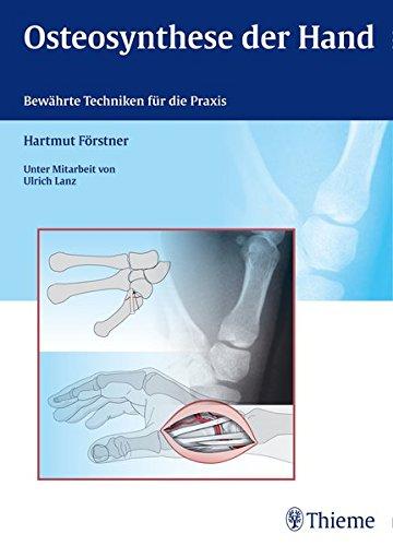 Osteosynthese der Hand: Bewährte Techniken für die Praxis