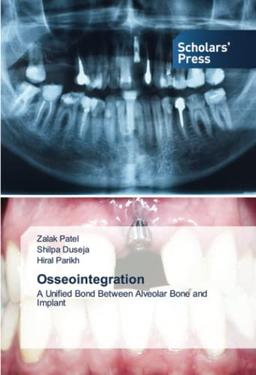 Osseointegration: A Unified Bond Between Alveolar Bone and Implant