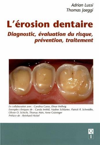 L'érosion dentaire : diagnostic, évaluation du risque, prévention, traitement