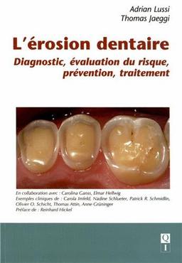 L'érosion dentaire : diagnostic, évaluation du risque, prévention, traitement