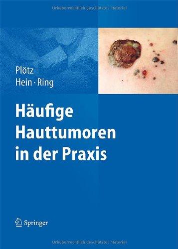 Häufige Hauttumoren in der Praxis