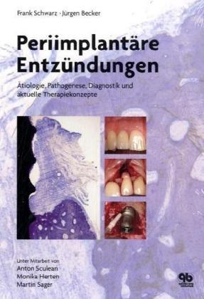 Periimplantäre Entzündungen: Ätiologie, Pathogenese, Diagnostik und aktuelle Therapiekonzepte