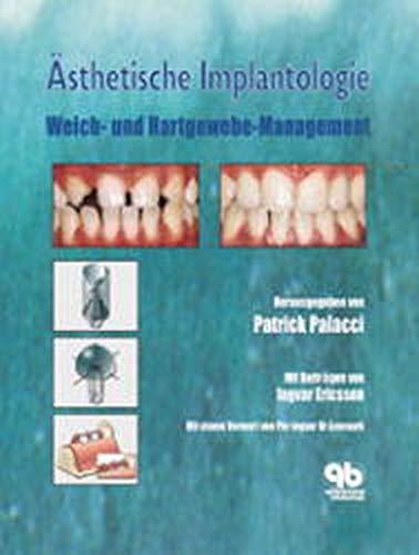 Ästhetische Implantologie: Weich- und Hartgewebe-Management