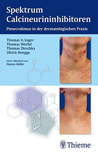 Spektrum Calcineurininhibitoren: Pimecrolimus in der dermatologischen Praxis