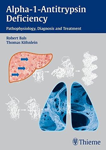 Alpha-1-Antitrypsin Deficiency: Pathophysiology, Diagnosis and Treatment