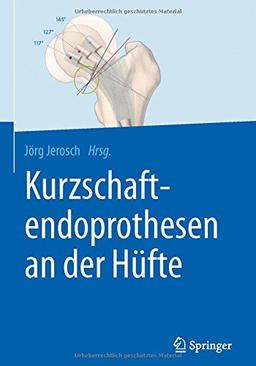 Kurzschaftendoprothesen an der Hüfte