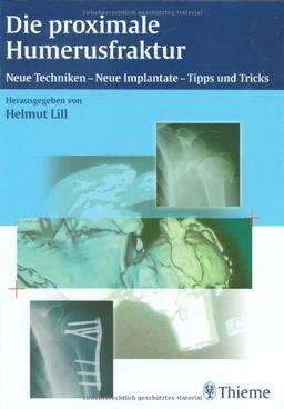 Die proximale Humerusfraktur: Neue Techniken, Neue Implantate - Tipps und Tricks