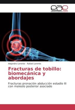 Fracturas de tobillo: biomecánica y abordajes: Fracturas pronación abducción estadío III con maleolo posterior asociado