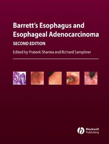 Sharma, P: Barrett′s Esophagus and Esophageal Adenocar