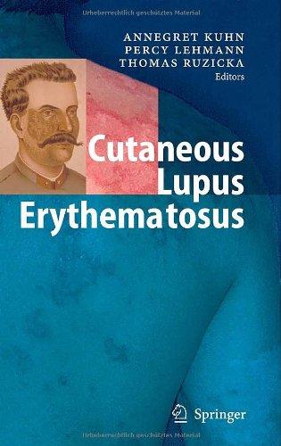 Cutaneous Lupus Erythematosus