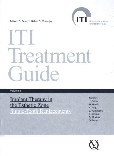 ITI Treatment Guide: Volume 1: Implant Therapy in the Esthetic Zone, Single-Tooth Replacements (ITI Treatment Guides)